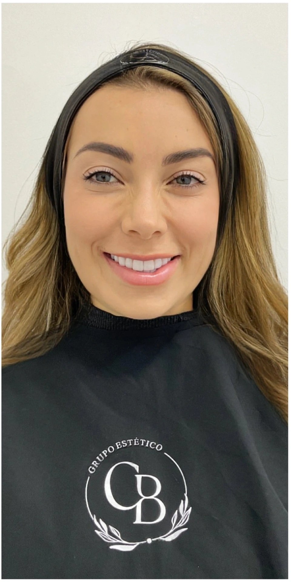 Después — Botox · Frente y entrecejo